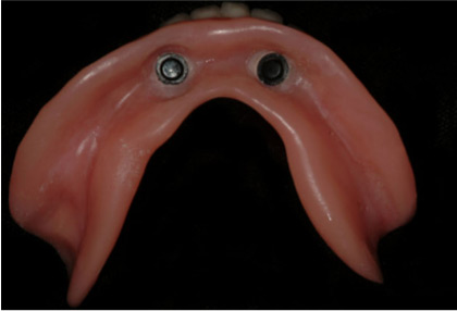 Полная реабилитация нижней челюсти