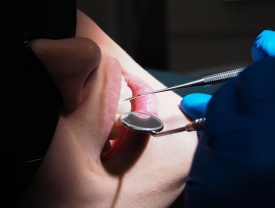 При лечении кариеса двух зубов в одно посещение, на второй скидка 20%